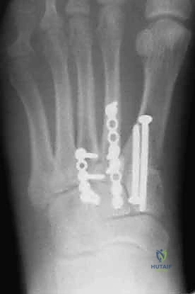 صورة طبية: إصابة ليزفرانك: دليل شامل للتشخيص والعلاج الجراحي الدقيق في صنعاء مع الأستاذ الدكتور محمد هطيف