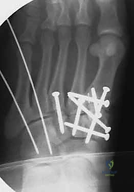 صورة طبية: إصابة ليزفرانك: دليل شامل للتشخيص والعلاج الجراحي الدقيق في صنعاء مع الأستاذ الدكتور محمد هطيف