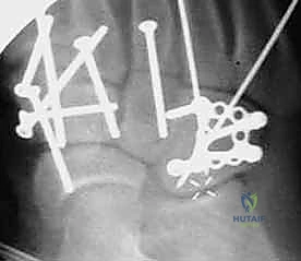 صورة طبية: إصابة ليزفرانك: دليل شامل للتشخيص والعلاج الجراحي الدقيق في صنعاء مع الأستاذ الدكتور محمد هطيف