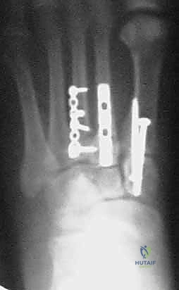 صورة طبية: إصابة ليزفرانك: دليل شامل للتشخيص والعلاج الجراحي الدقيق في صنعاء مع الأستاذ الدكتور محمد هطيف