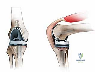Revision Total Knee Arthroplasty: Mastering Tibial Bone Loss with Metal Augments