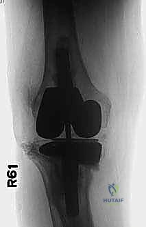 صورة توضيحية لـ جراحة مراجعة استبدال مفصل الركبة: التعامل مع فقدان العظم في الساق باستخدام الدعامات المعدنية مع الأستاذ الدكتور محمد هطيف