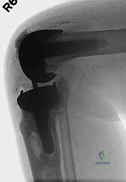 صورة توضيحية لـ جراحة مراجعة استبدال مفصل الركبة: التعامل مع فقدان العظم في الساق باستخدام الدعامات المعدنية مع الأستاذ الدكتور محمد هطيف