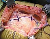 جراحة مراجعة استبدال مفصل الركبة: التعامل مع فقدان العظم في الساق باستخدام الدعامات المعدنية مع الأستاذ الدكتور محمد هطيف