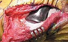 الدعامات المعدنية المستخدمة في جراحة المراجعة