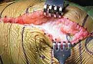 تشخيص فشل المفصل وتآكل العظام