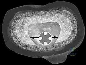 إزالة المفصل القديم بحذر