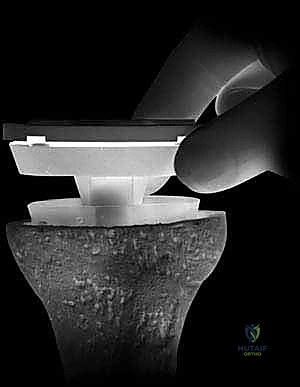 تجهيز عظم الساق وتركيب الدعامات