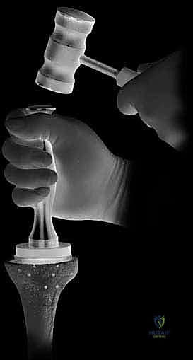 التخطيط الدقيق قبل الجراحة مع الدكتور محمد هطيف