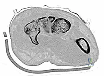 تثبيت العظم بالمسامير الدقيقة