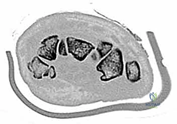 أشعة توضح مضاعفات إهمال الكسر