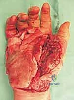 صورة توضيحية لـ كسور عظام الرسغ غير الزورقية: دليل شامل للمرضى مع الأستاذ الدكتور محمد هطيف في صنعاء