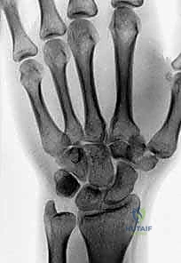 متابعة التئام العظم بالأشعة