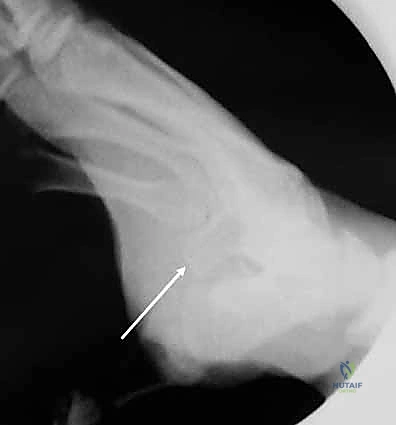 كسور عظام الرسغ غير الزورقية: دليل شامل للمرضى مع الأستاذ الدكتور محمد هطيف في صنعاء