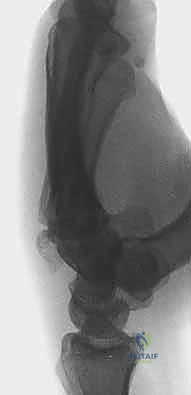 التثبيت الدقيق للعظم الكبير