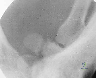 تفاصيل التثبيت الداخلي