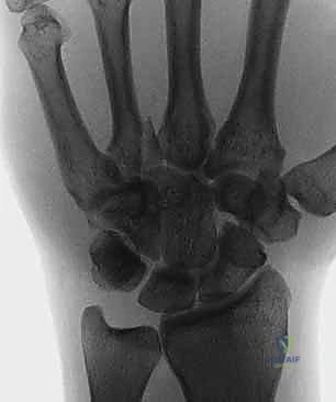 جلسة علاج طبيعي للرسغ