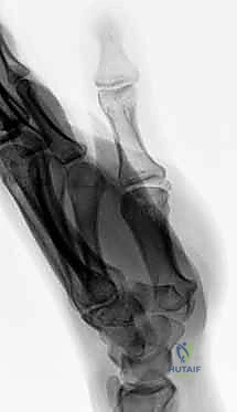 صورة أشعة قبل وبعد الجراحة