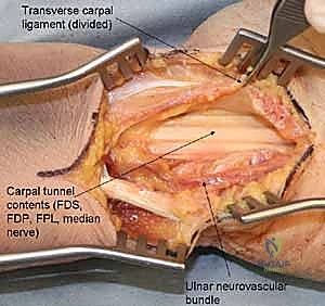 صورة توضيحية لـ كسور عظام الرسغ غير الزورقية: دليل شامل للمرضى مع الأستاذ الدكتور محمد هطيف في صنعاء