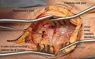 إغلاق الجرح التجميلي