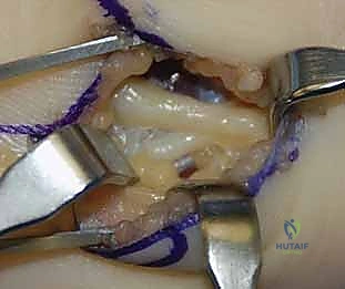 أدوات التثبيت المصنوعة من التيتانيوم