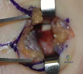 تقييم الأربطة المحيطة