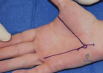 تحضير المريض للعملية