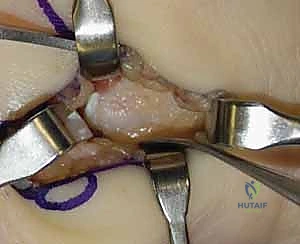 متابعة استقرار المفصل