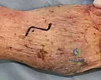 تثبيت نهائي للعظام