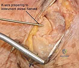 الجبس الطبي كخيار تحفظي