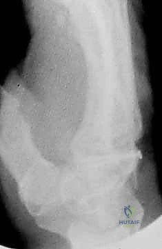 الجبيرة الداعمة بعد العملية