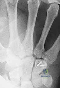 صورة توضيحية لـ كسور عظام الرسغ غير الزورقية: دليل شامل للمرضى مع الأستاذ الدكتور محمد هطيف في صنعاء