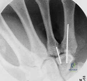 صعوبة التشخيص بالأشعة العادية