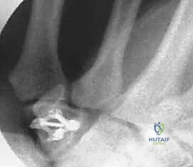 شكل الجرح بعد الإغلاق