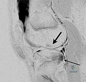 صورة رنين مغناطيسي سهمي عبر الجانب الجانبي للركبة
