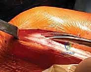 تحديد مسار النفق العظمي بعيداً عن صفيحة النمو