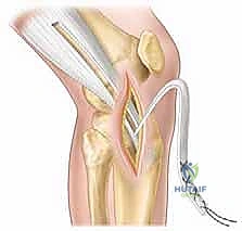 إعادة بناء الرباط الصليبي الأمامي عند الأطفال والمراهقين: نهج يحافظ على صفائح النمو