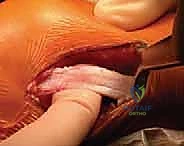 تجهيز الطعم الوتري لإعادة بناء الرباط الصليبي عند الأطفال