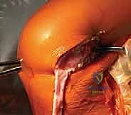 صورة توضيحية لـ إعادة بناء الرباط الصليبي الأمامي عند الأطفال والمراهقين: نهج يحافظ على صفائح النمو