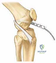 تثبيت الطعم الوتري باستخدام مسامير تداخلية خاصة للأطفال