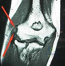 صورة توضيحية لـ التهاب اللقيمة الوحشية (مرفق التنس): دليل شامل للعلاج بالمنظار مع الأستاذ الدكتور محمد هطيف