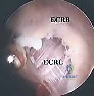 Illustration of treatment of epicondylitis - Dr. Mohammed Hutaif