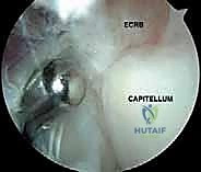 صورة للمنظار المفصلي أثناء العملية
