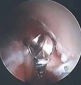 التهاب اللقيمة الوحشية (مرفق التنس): دليل شامل للعلاج بالمنظار مع الأستاذ الدكتور محمد هطيف