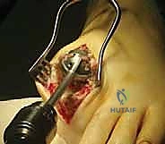 الأدوات الجراحية والتقنيات الحديثة المستخدمة في دمج المفصل بواسطة د. محمد هطيف