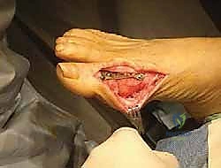 Illustration of metatarsophalangeal joint arthrodesis - Dr. Mohammed Hutaif