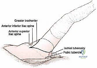 Hip Disarticulation: An Advanced Intraoperative Masterclass