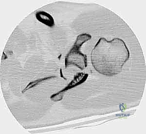Illustration of fractures of the glenoid - Dr. Mohammed Hutaif