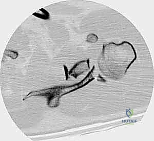مقدمة كسور لوح الكتف