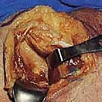 خيارات علاج كسور الكتف